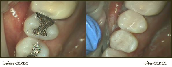 CEREC Before and After